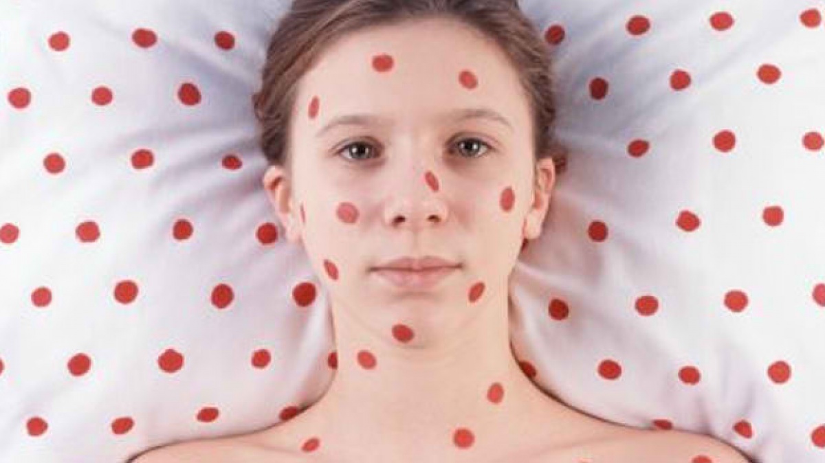 Жители Нижегородской области могут получить бесплатную прививку от кори по месту жительства до 1 октября