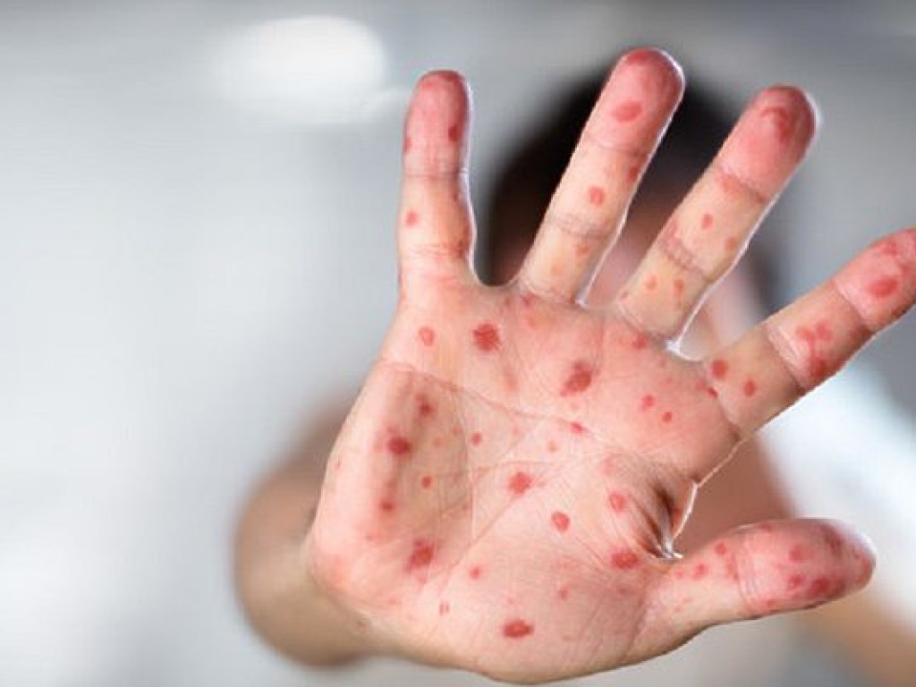 Два слу­чая ко­ри за­ре­ги­стри­ро­ва­ли в Ни­же­го­род­ской об­ла­сти