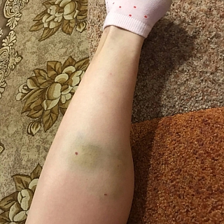 Количество искусанных агрессивной собакой исчисляется десятками 3