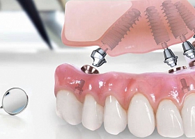 Несъемное протезирование ( все на 4-х имплантах)