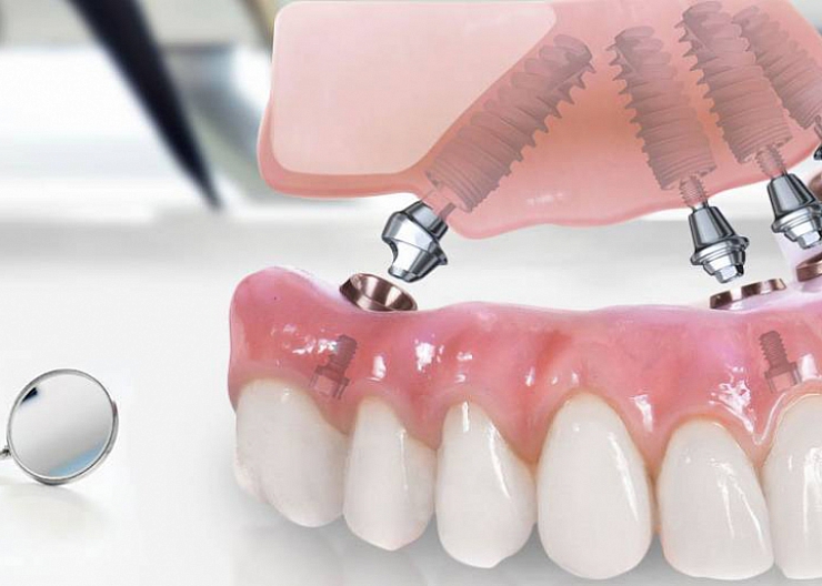 Несъемное протезирование ( все на 4-х имплантах)